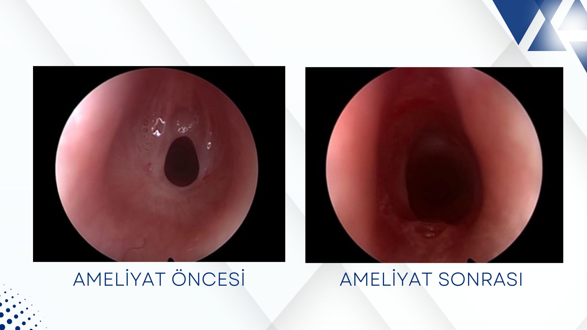 Endoskopik havayolu cerrahisi - Doç. Dr. Serap Şahin Önder